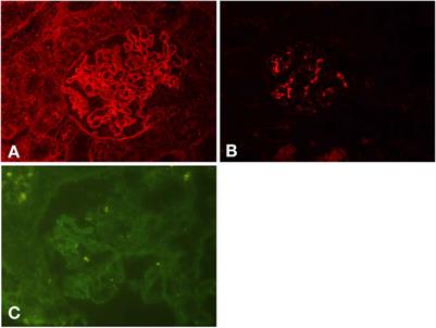Case Report: Coexistence of Anti-Glomerular Basement Membrane Disease, Membranous Nephropathy, and <mark class="highlighted">IgA Nephropathy</mark> in a Female PatientWith Preserved Renal Function